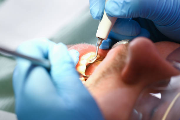 Best Emergency Root Canal Treatment in Bridgman, MI