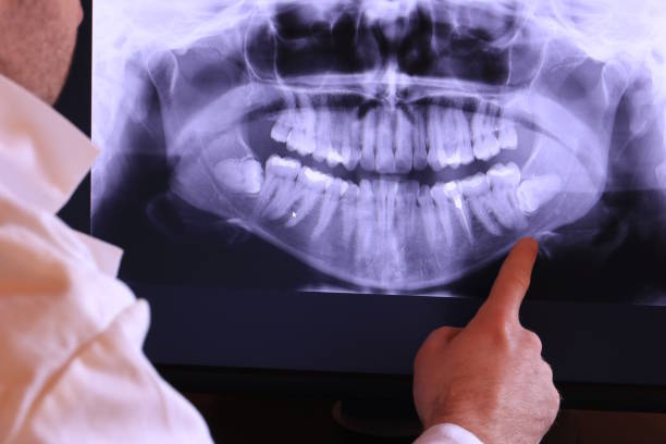 Best Emergency Wisdom Teeth Removal in Bridgman, MI